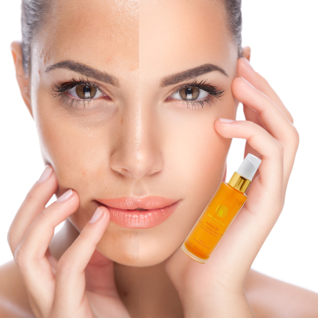 Introducing Our Reform Oil: Your Solution for Acne, Eczema, Wrinkles, Scars, and Uneven Skin Tone